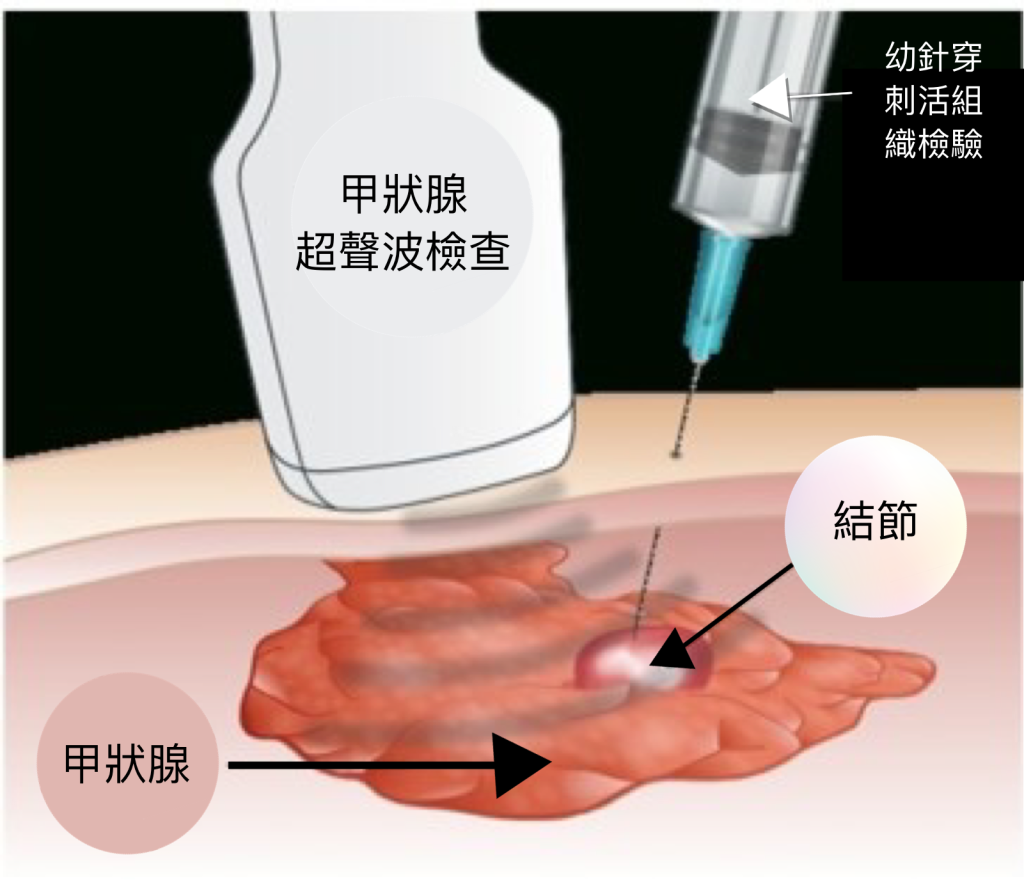 甲狀腺癌, 甲狀腺檢查, 甲狀腺超聲波, 甲狀腺幼針穿刺活組織檢驗, 甲狀腺結節, 甲狀腺疾病, 大頸泡
